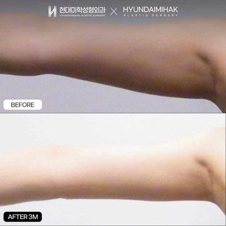 Мини-липосакция рук: как быстро и безопасно стать красивее
