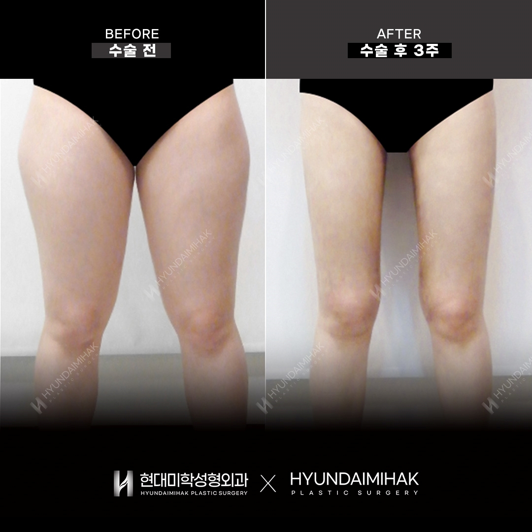 Липосакция бедер, 3 недели