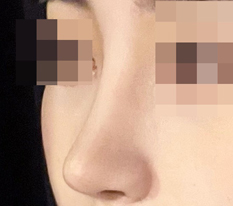 I recommend Гёндэ Михак to anyone who wants pretty nose surgery!!!!!