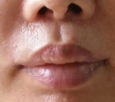 Уменьшение внешней части фильтрума