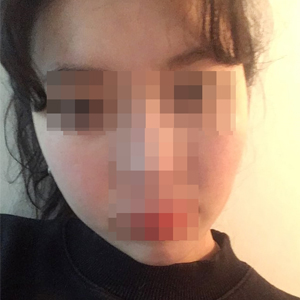 Всего одна операция на скулах, а…