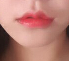 Lip surgery at Гёндэ Михак is seriously highly recommended;