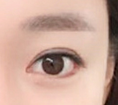 I had revision canthoplasty at Гёндэ Михак, the best~