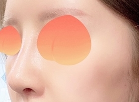 Гёндэ Михак is great for noses hehe