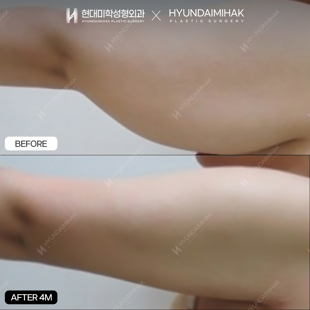 Липосакция рук, 4-й месяц