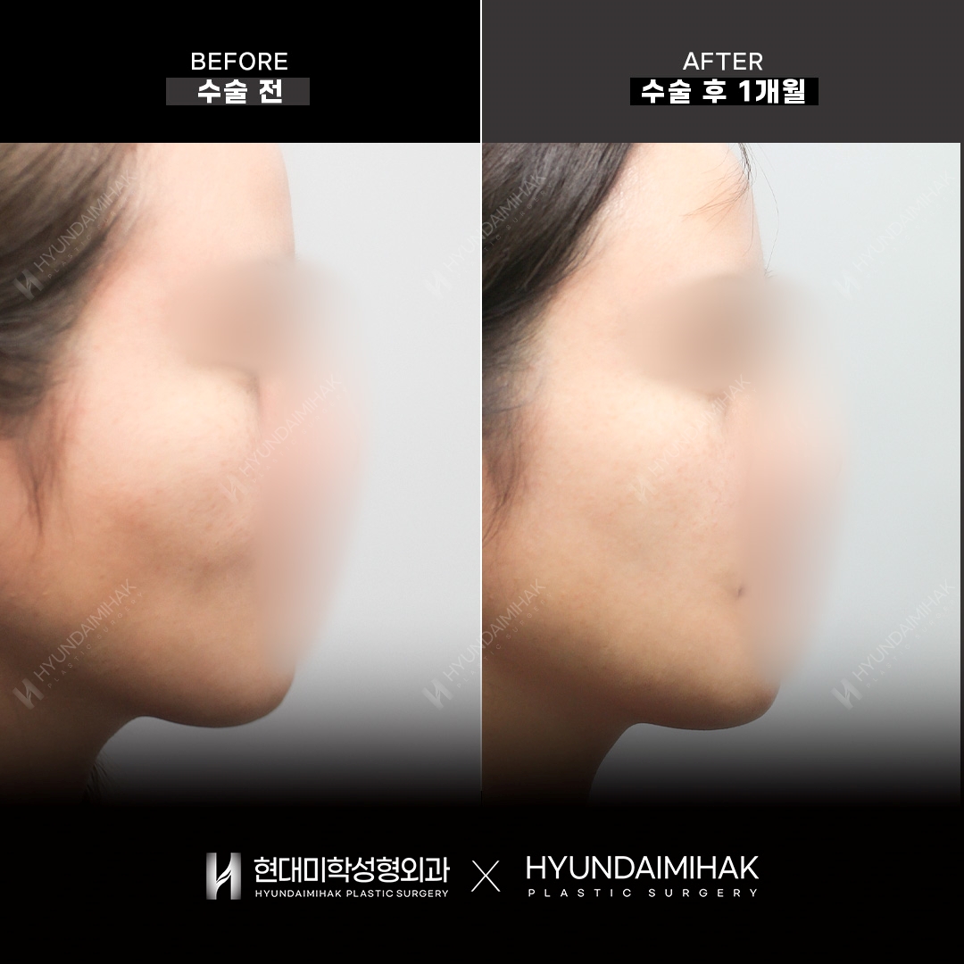 Facial Fat KILL (контурные инъекции), 1 месяц