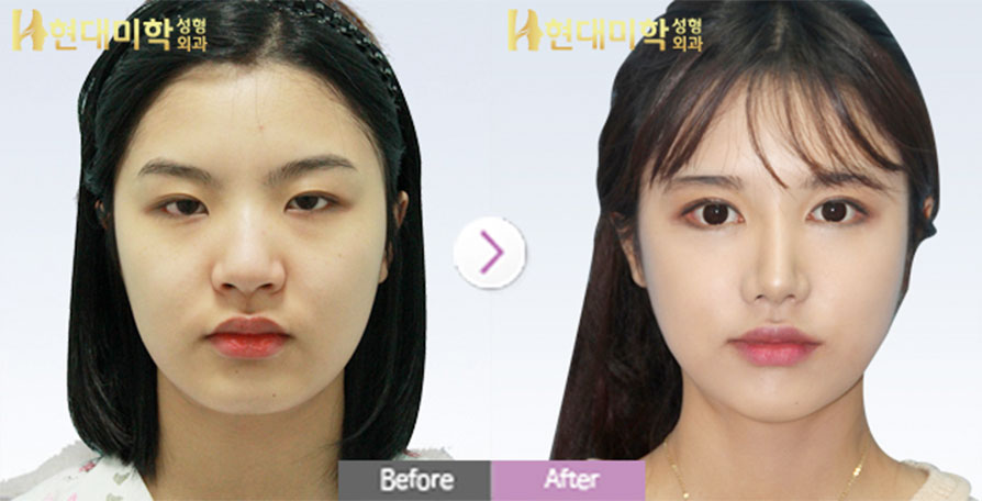 Безразрезная пластика двойного века, эпикантопластика, латеральная кантопластика, ринопластика, перегородка, латеральная остеотомия, силикон, кончик носа, уменьшение крыльев носа