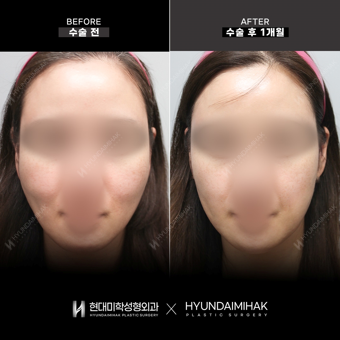 Facial Fat KILL (контурные инъекции), 1 месяц