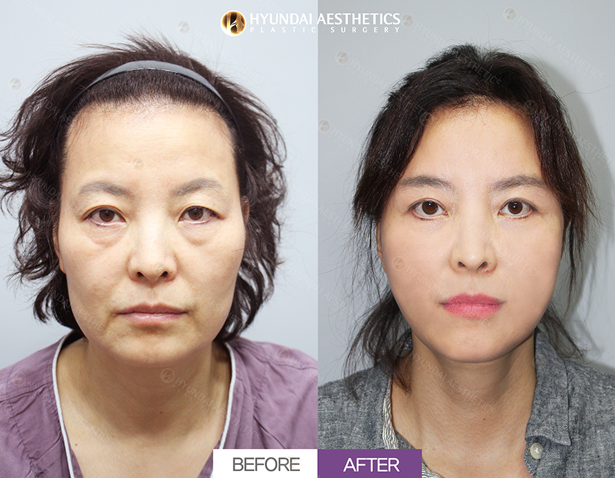 REAL SMAS-подтяжка лица