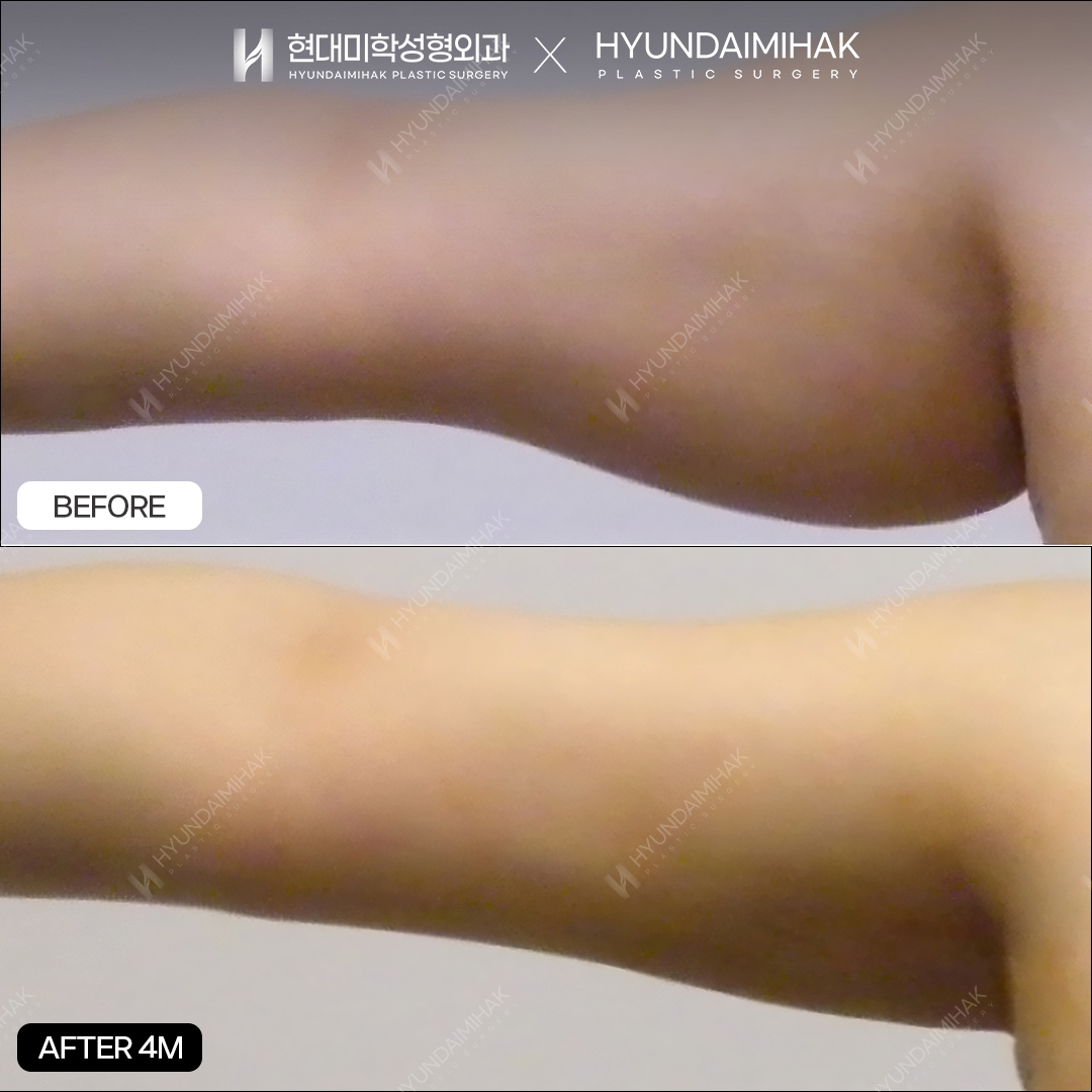 Липосакция рук, 4 месяца после операции