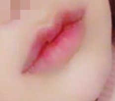 I highly recommend Гёндэ Михак mouth-corner + Cupid lip surgery