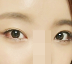 Я сделала Perfect Big Eye + двойную кантопластику