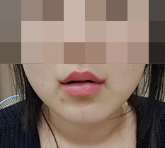Я сделала пластику уголков губ~~