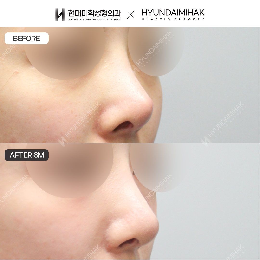 [Повторная ринопластика] Спинка носа + кончик носа, 6 месяцев
