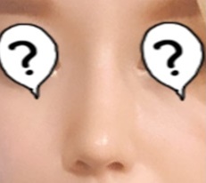 My unattractive nose changed my whole image after rhinoplasty at Гёндэ Михак!