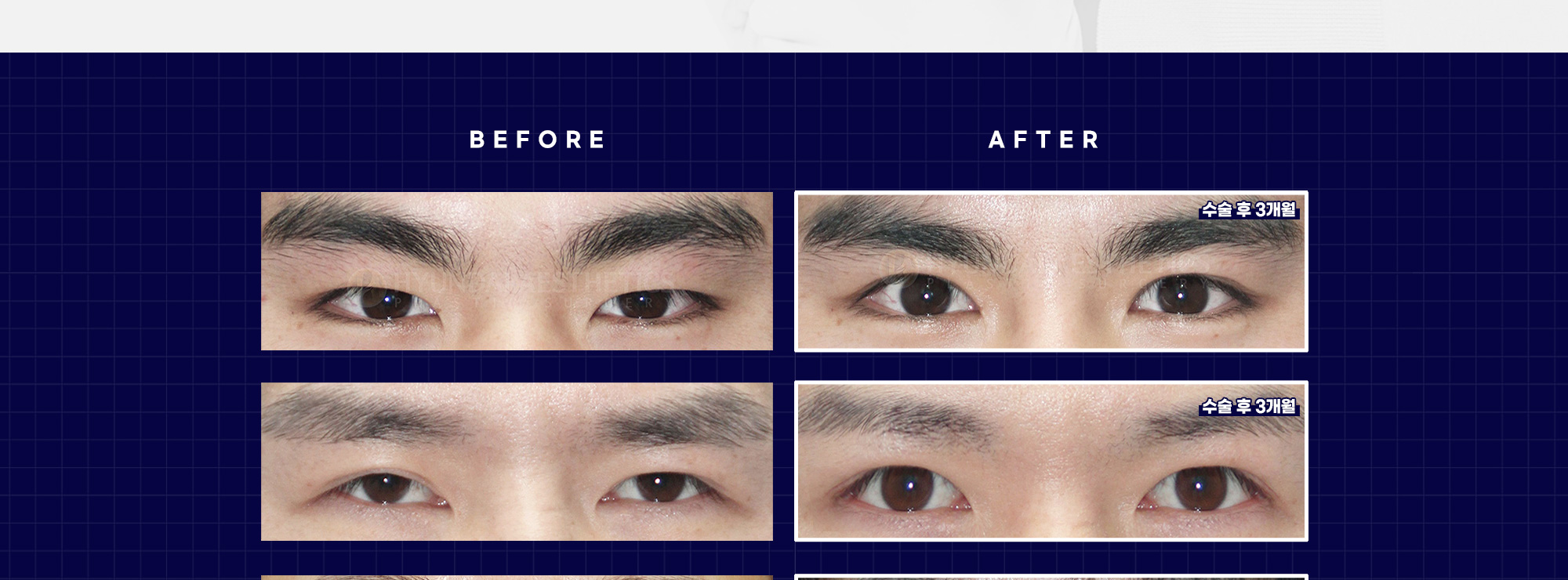 Мужская блефаропластика BEFORE & AFTER — через 3 месяца после операции