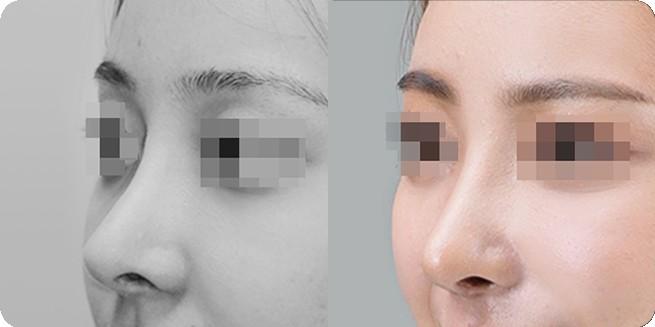 Сравнение профиля до и после ринопластики без имплантов 1 (BEFORE / AFTER 3MONTH)