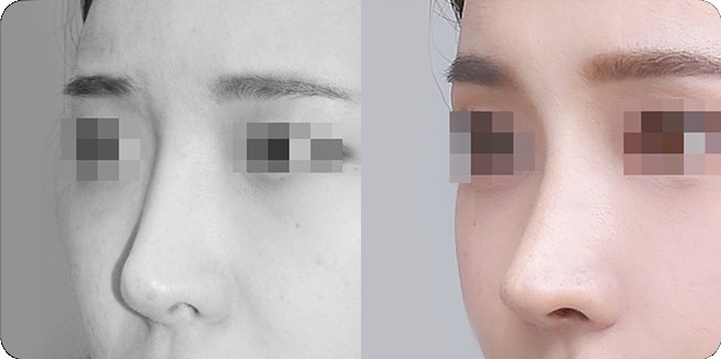 Сравнение профиля до и после ринопластики без имплантов 2 (BEFORE / AFTER 3MONTH)