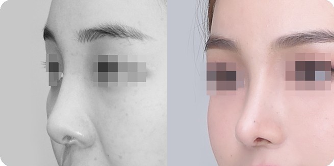 Сравнение профиля до и после ринопластики без имплантов 3 (BEFORE / AFTER 3MONTH)