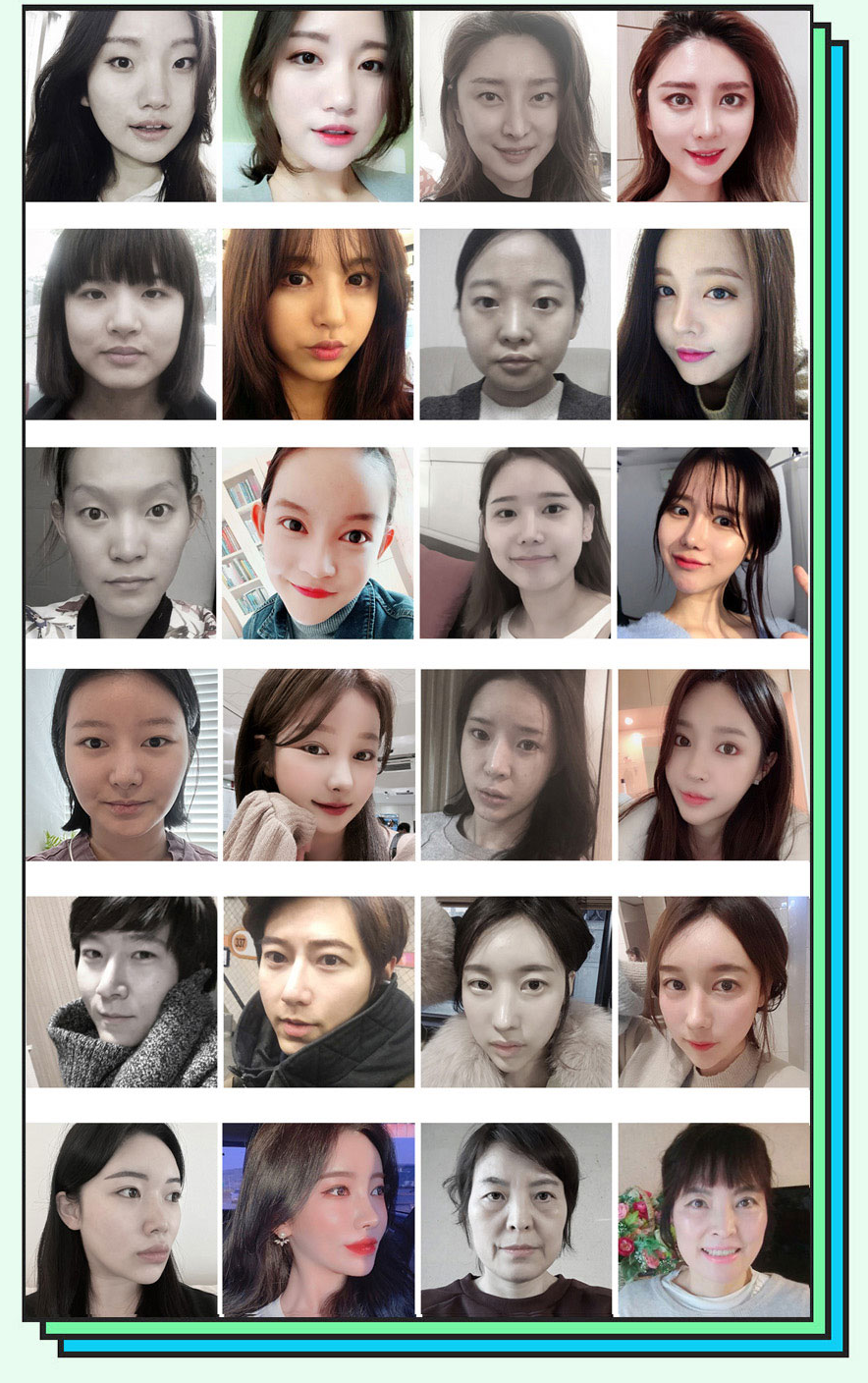 Сравнительные фотографии до и после ринопластики искривленного носа в Hyundai Aesthetics